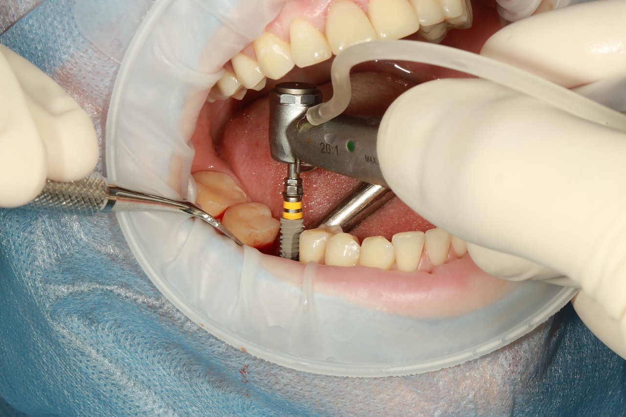Máte dostatek informací o zubních implantátech?